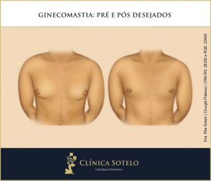ginecomastia antes e depois