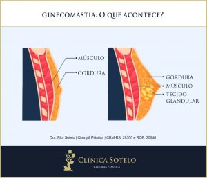 ginecomastia causas