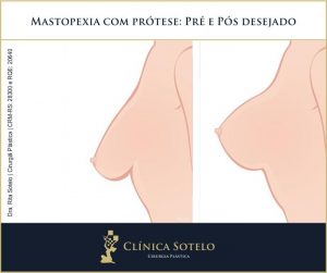 mastopexia com protese