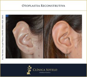 otoplastia reconstrução de orelhas