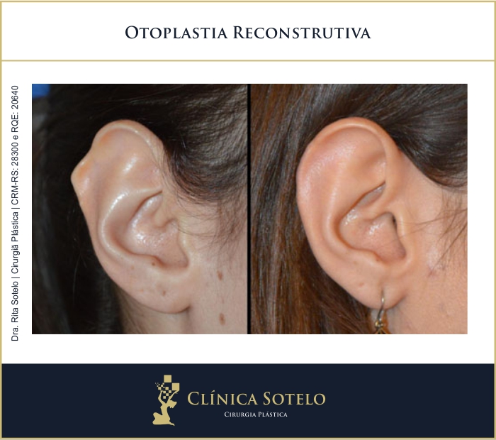 Otoplastia Conheça a cirurgia de orelha de abano e outras Lajeado RS