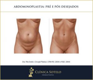 abdominoplastia antes e depois