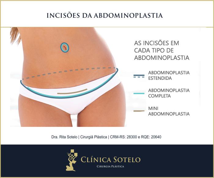 Abdominoplastia e Mini Abdominoplastia Qual a diferença Lajeado RS