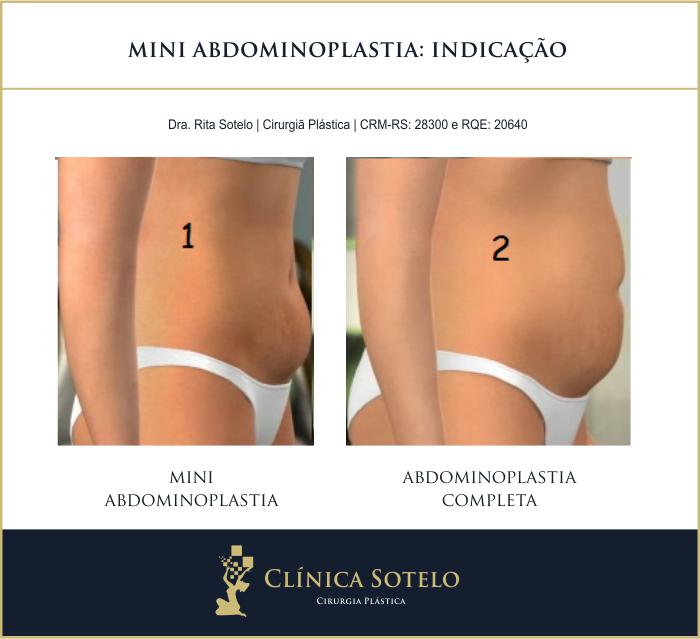 Abdominoplastia e Mini Abdominoplastia Qual a diferença Lajeado RS