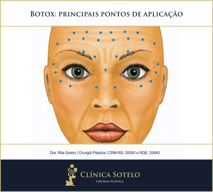 Botox Evita Rugas Futuras Tudo Sobre A Toxina Botulinica Lajeado Rs