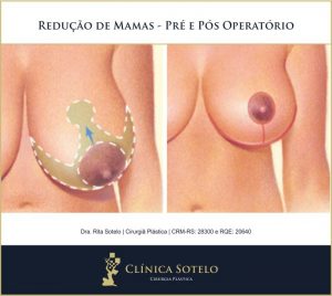 redução de mama antes e depois