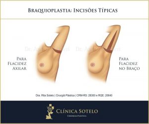 braquioplastia cicatrizes