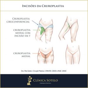 cruroplastia-cicatrizes